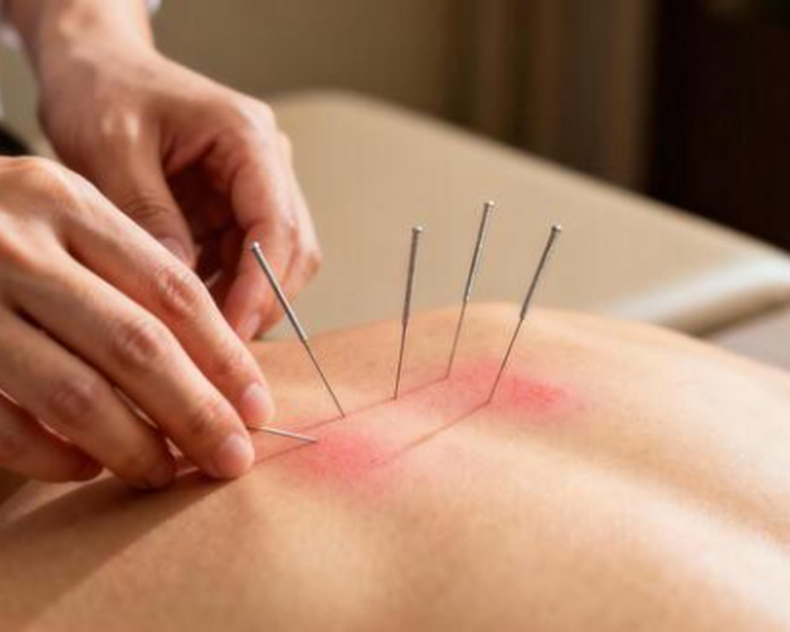 Quatre aiguilles dans les muscles du dos pendant un traitement de dry needling.